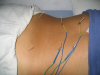 Acupuncture!
